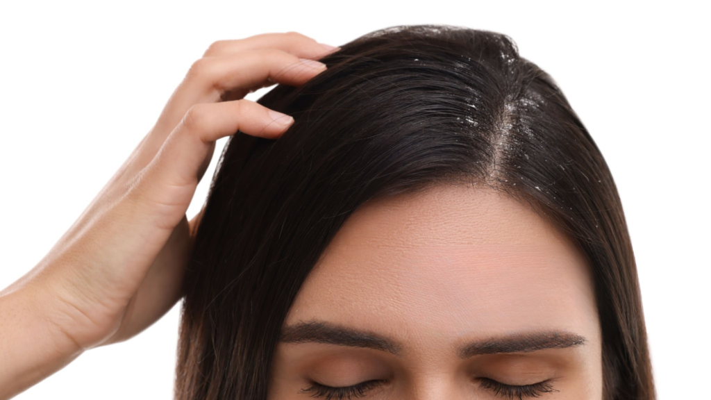 Everyday Habits That Help Prevent Dandruff